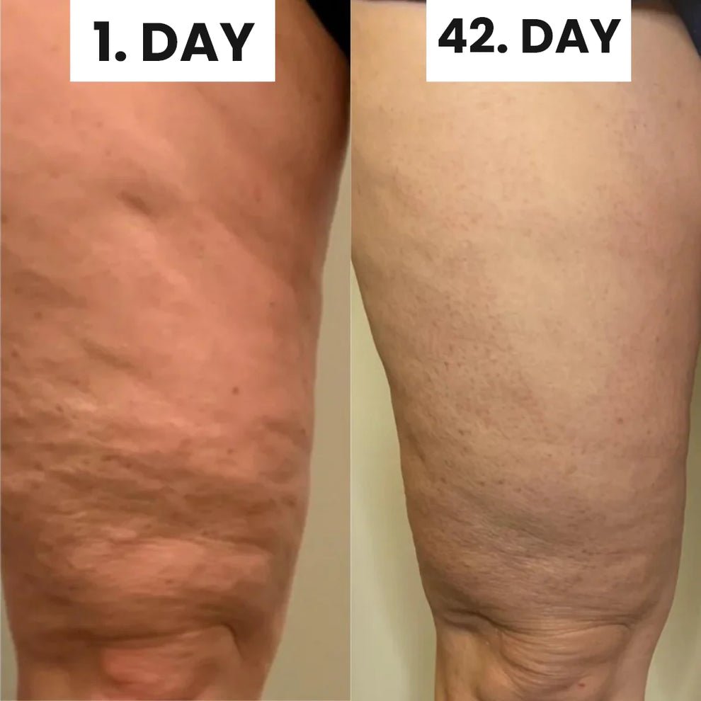 SheVitality cellulite verwijdering